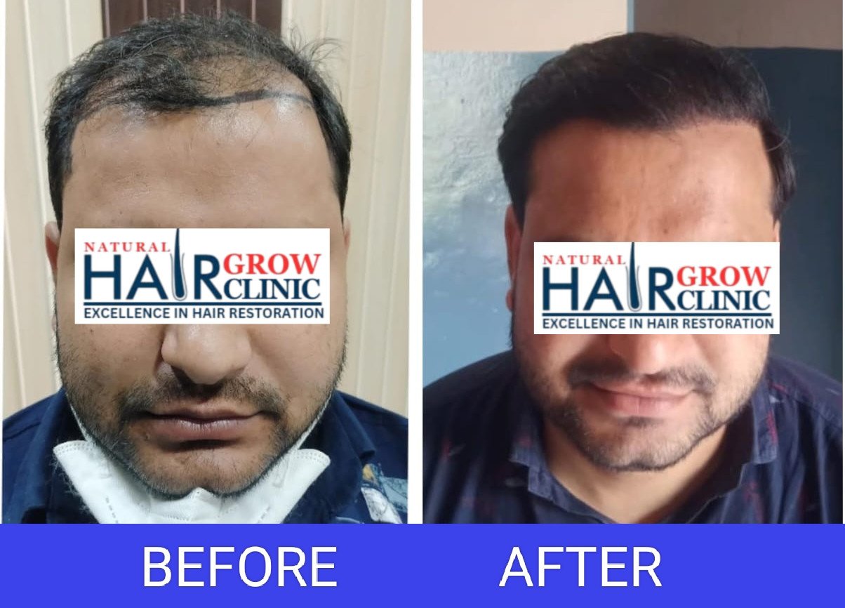 Hair Transplant Result