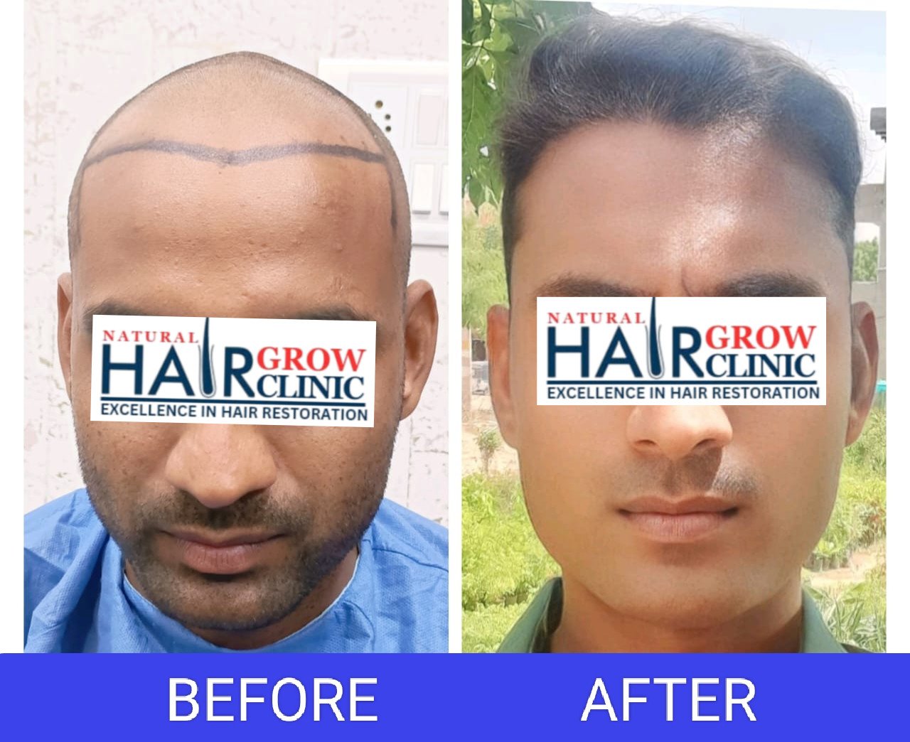 Hair Transplant Result