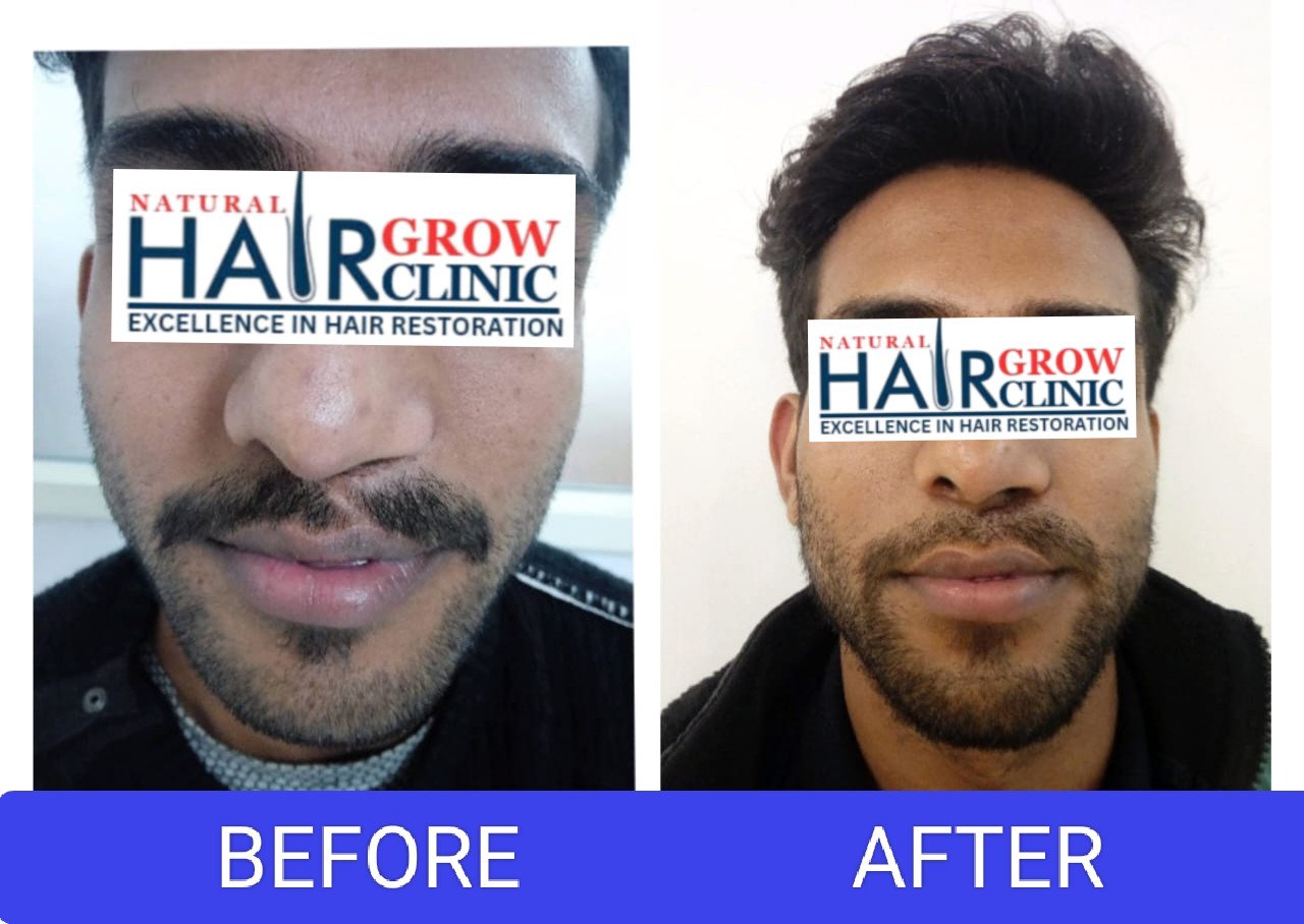 Hair Transplant Result