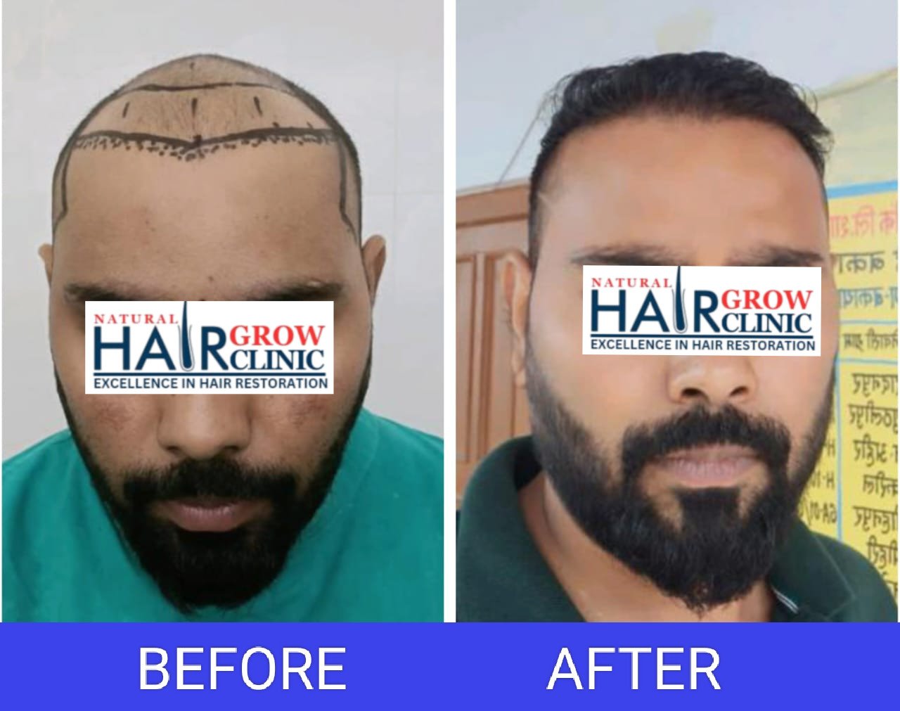 Hair Transplant Result