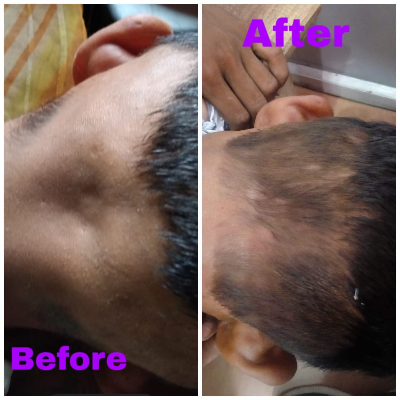 Alopecia Areata Treatment