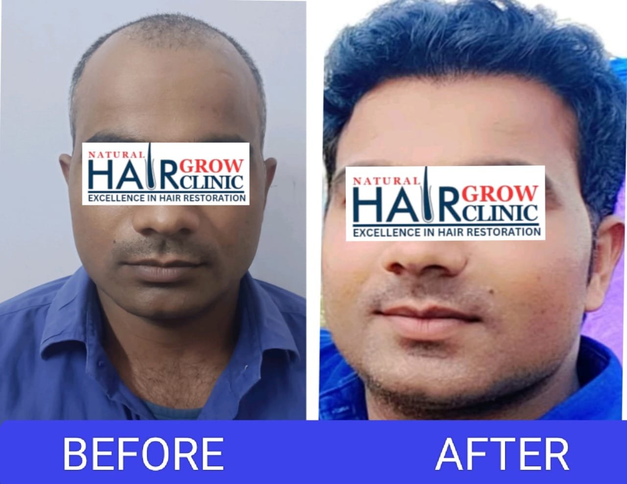 Hair Transplant Result