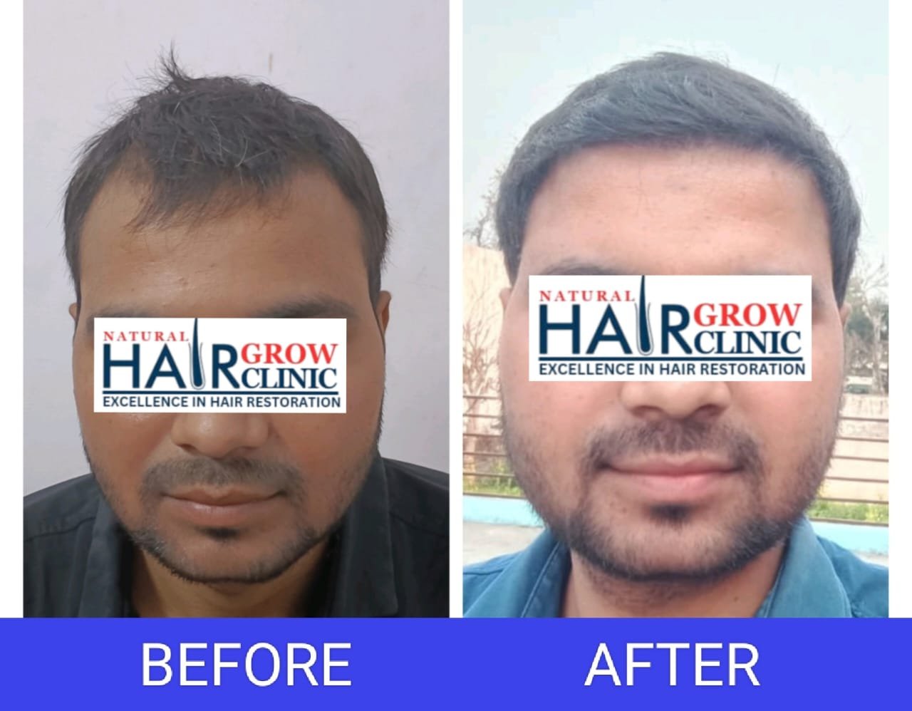 Hair Transplant Result