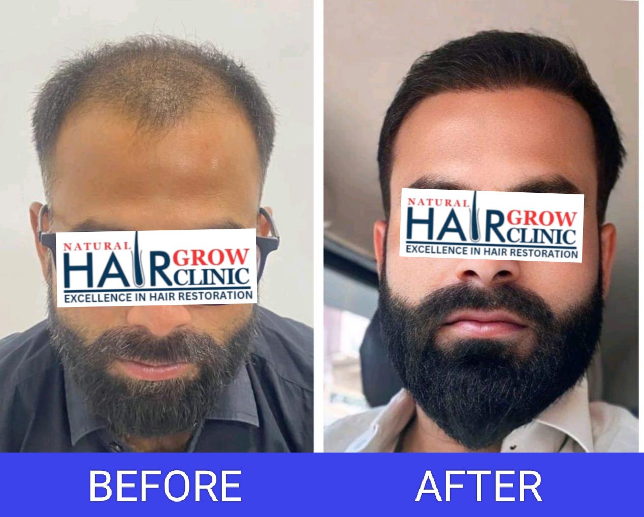 Hair Transplant Result