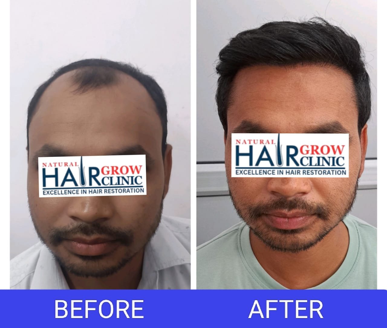 Hair Transplant Result