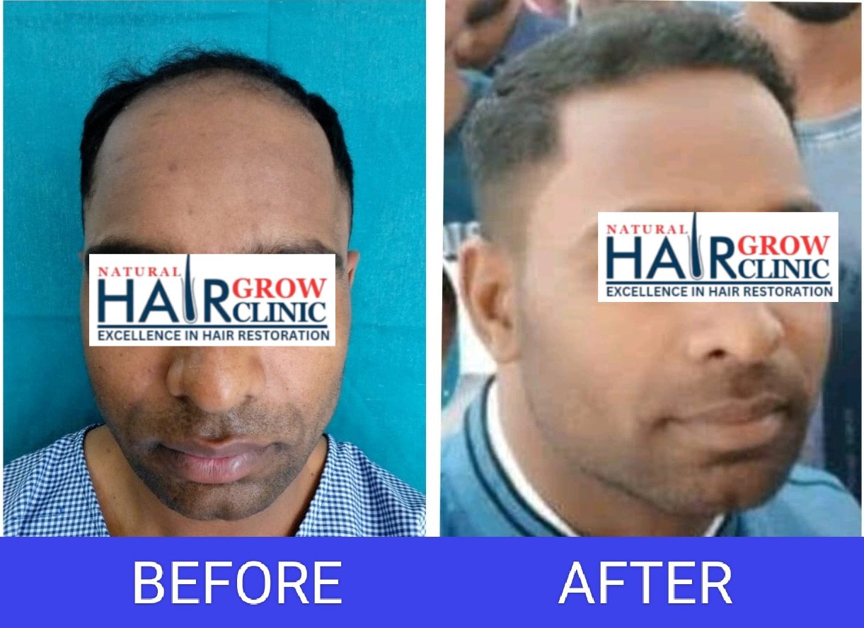 Hair Transplant Result